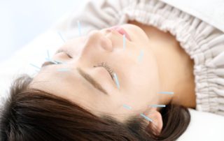 Acupuncture headache