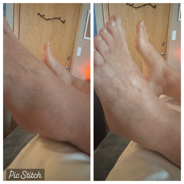 Planning for Recovery: The Role of Lymphatic Massage Before and After Surgery 2 Before & After Results