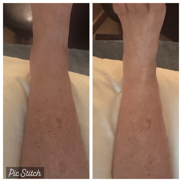 Planning for Recovery: The Role of Lymphatic Massage Before and After Surgery 3
